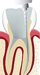 dévitalisation carie endodontie