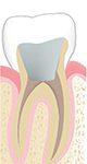 dévitalisation carie endodontie